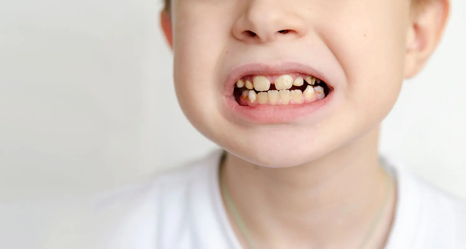 Why Are My Kid’s Teeth Yellow?