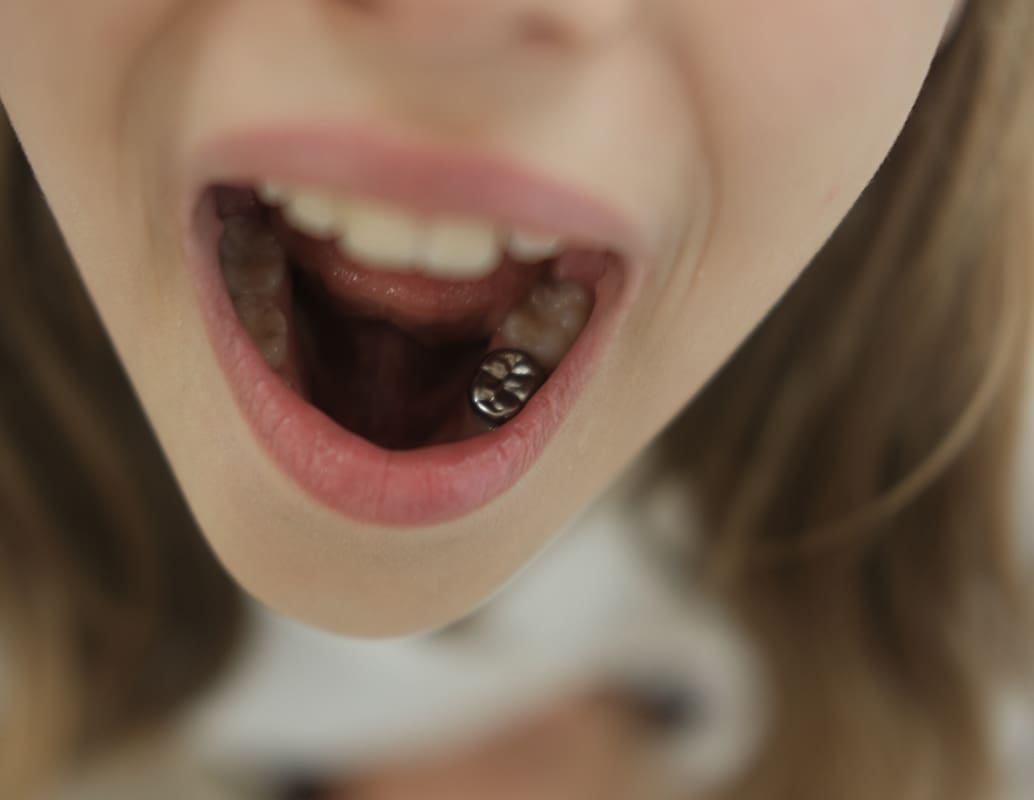 Pediatric Dental Crowns