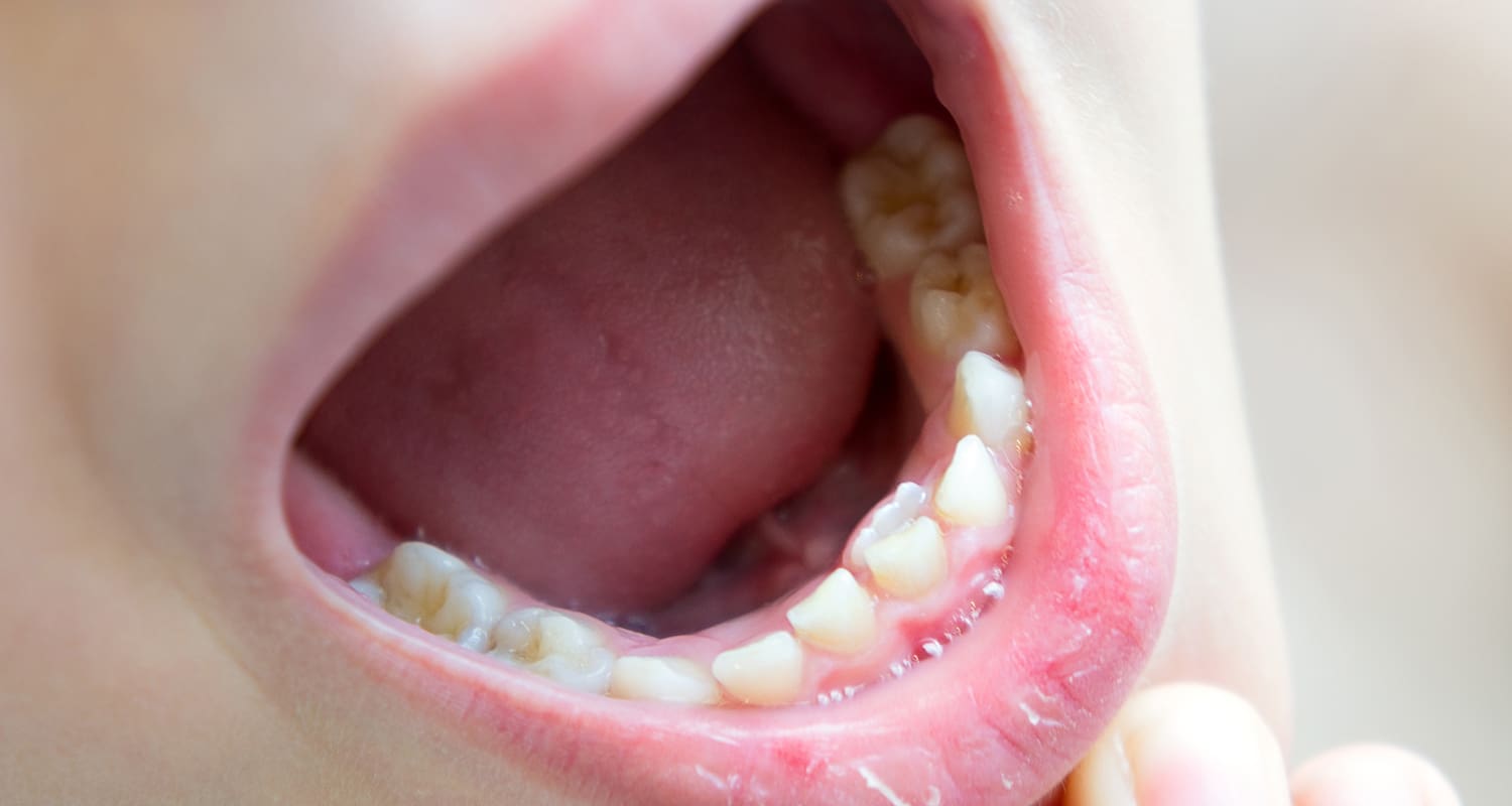 Shark Teeth in Kids: Normal or a Problem?