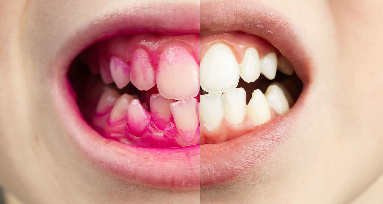 Plaque Disclosing Tablets: A Simple Way to Improve Brushing Habits