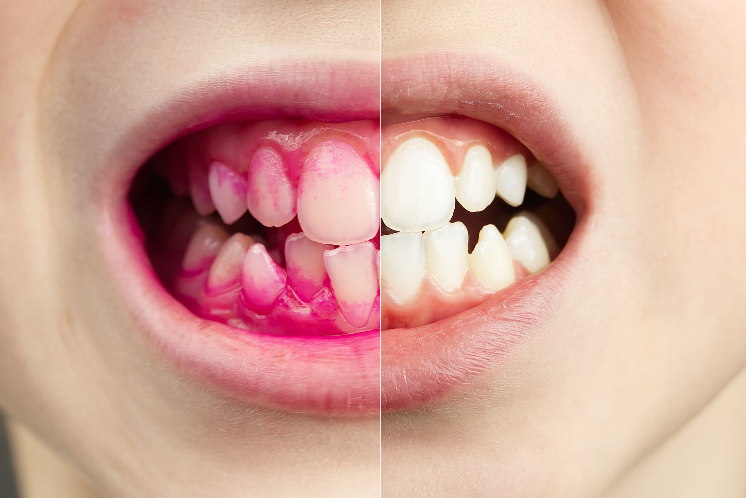 Plaque Disclosing Tablets: A Simple Way to Improve Brushing Habits