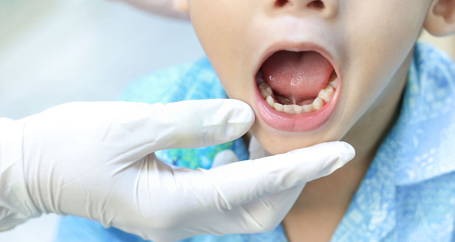 Tongue Tie and Lip Tie in Children: Signs, Symptoms, and Treatment