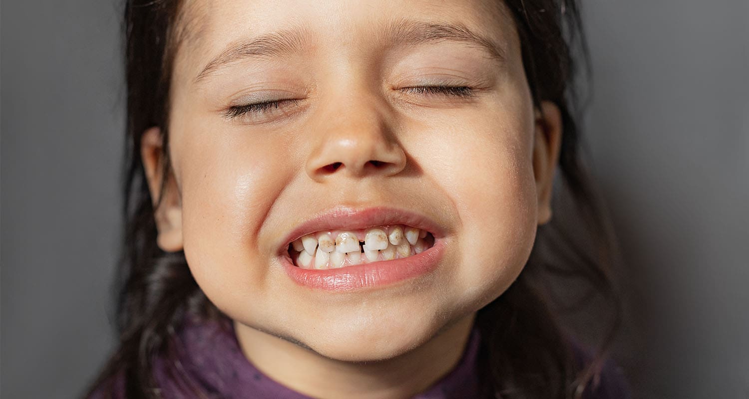 Hypoplastic Teeth: What They Mean for Your Child's Oral Health